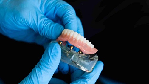 modélisation prothèse dentaire